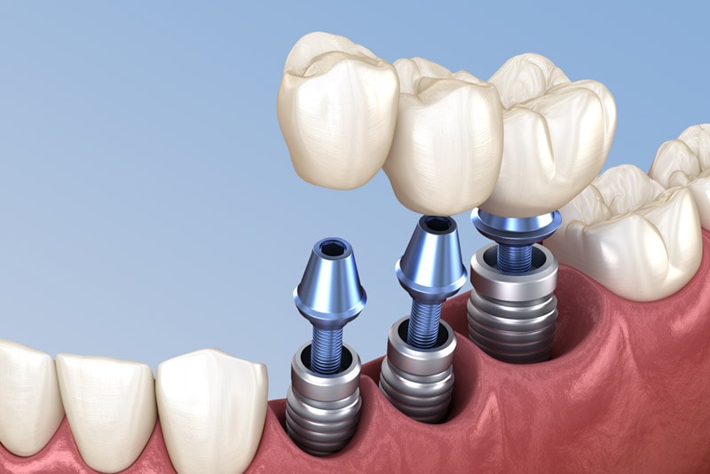 3 Single Dental Implants Replacing Pre-Molars