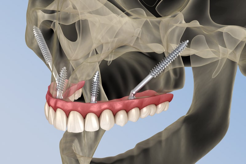 Zygomatic Dental Implants Supporting An All On 4 Dental Implant Prosthesis