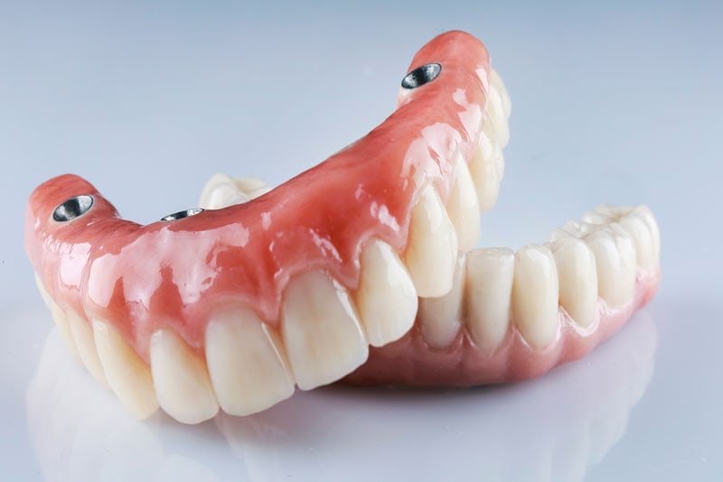 A Full Mouth Of All On 4 Dental Implant Prosthetic Models