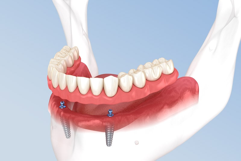 Snap On Denture On A Jaw Graphic